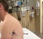 man impaled by a hiking pole treks 10 miles down mountain